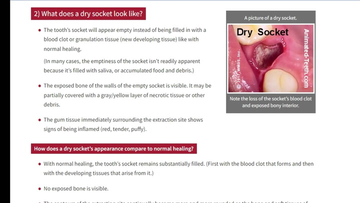 dry socket vs blood clot