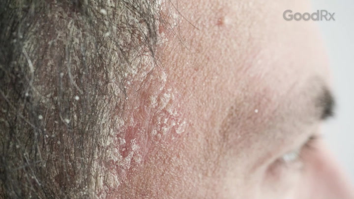 Psoriasis: closeup scalp with dandruff 1356695138